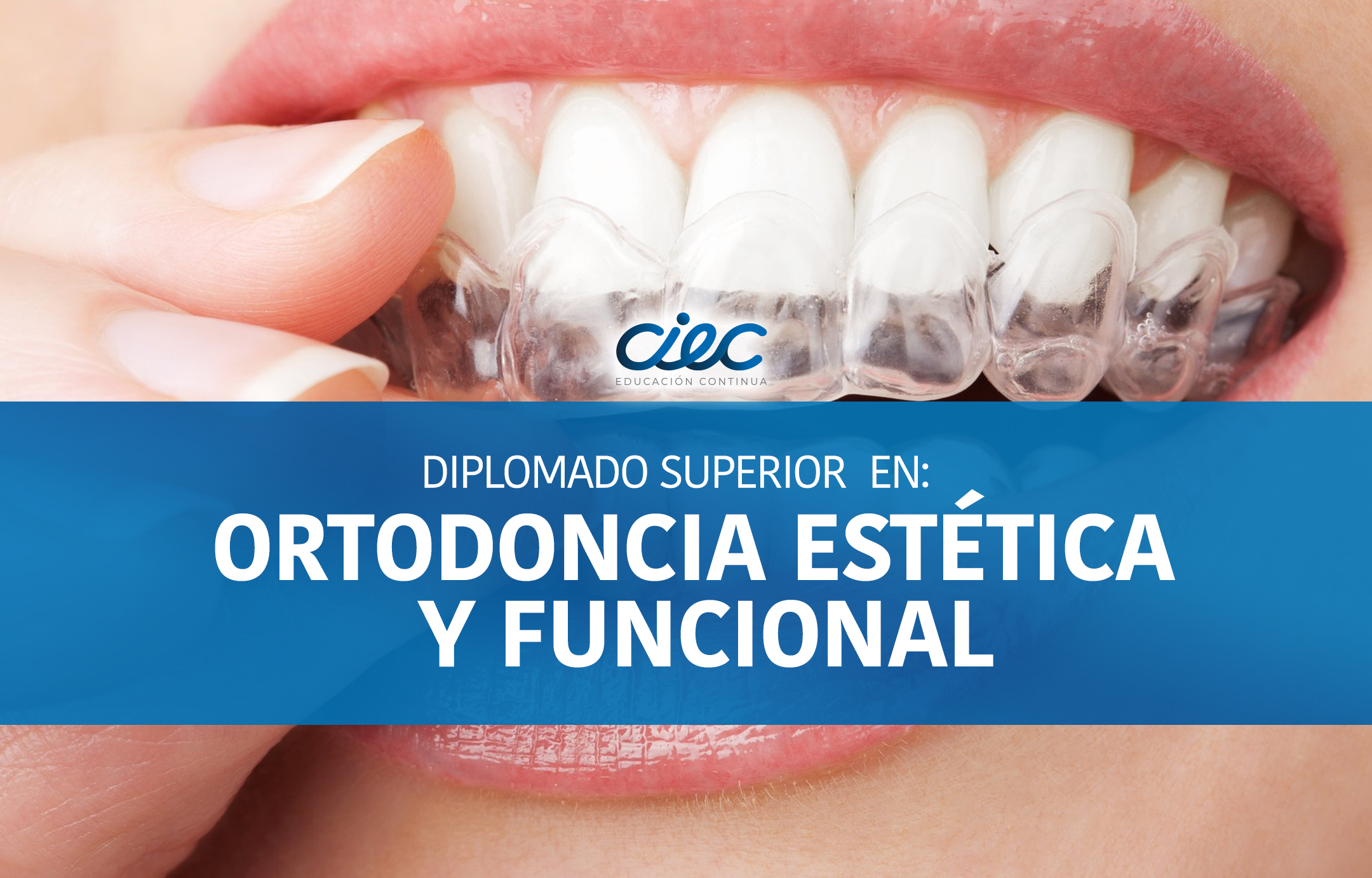 Diplomado Superior en Ortodoncia Estética y Funcional